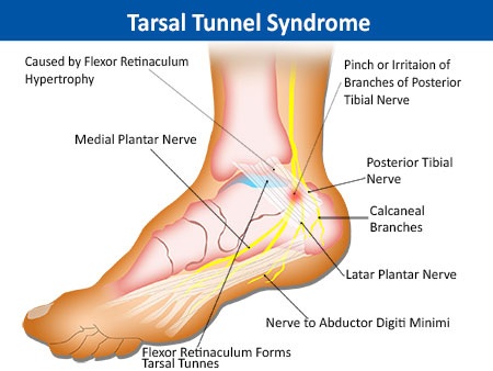 Tarsal-Tunnel syndrome.jpg